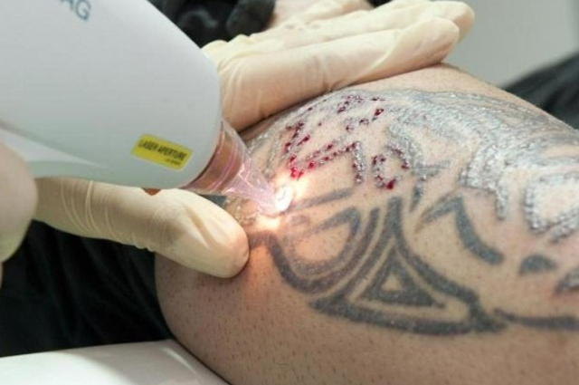 Laser Tatoo Removal